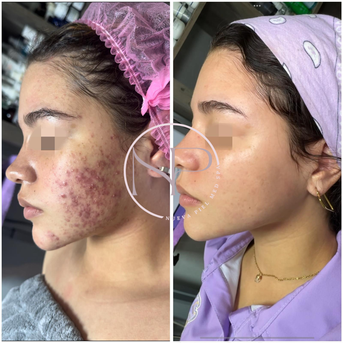 Tratamiento Integral para el Acné